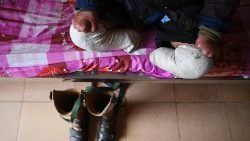 vietnam-health-leprosy-1548345852271.jpg
