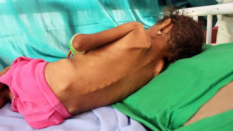 Trẻ em suy dinh dương tại Yemen