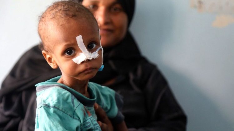 यमन ताइज में एक कुपोषित बच्ची का इलाज