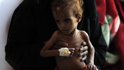 malnourished-children-caught-in-world-s-large-1541065272538.jpg