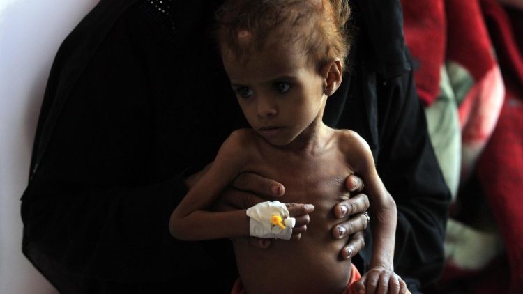 Un bambino malnutrito in un ospedale dello Yemen