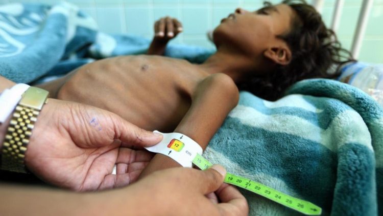 Bambino malnutrito nello Yemen
