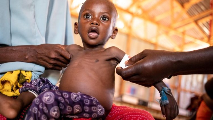 Criança somali sendo atendida por desnutrição 