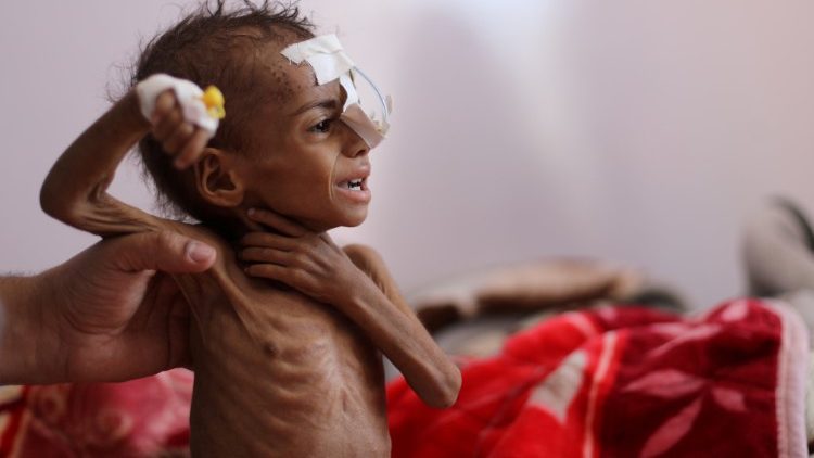 Unterernährtes Mädchen in einem Krankenhaus in Sanaa am 27. Oktober letzten Jahres
