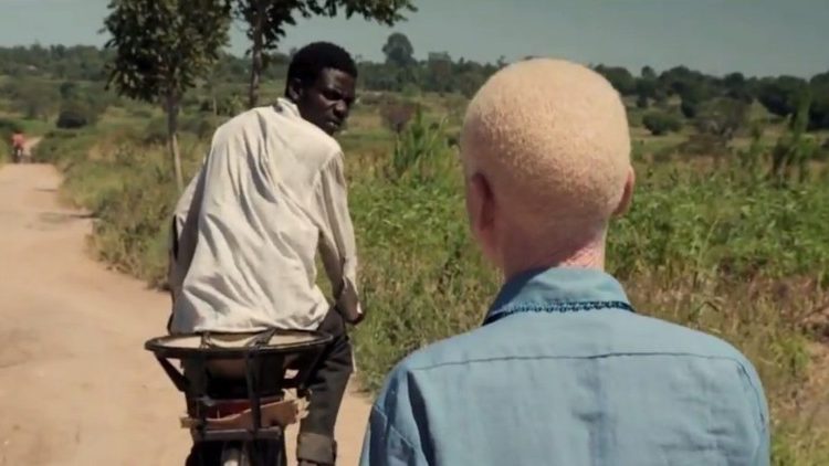 África, albinismo
